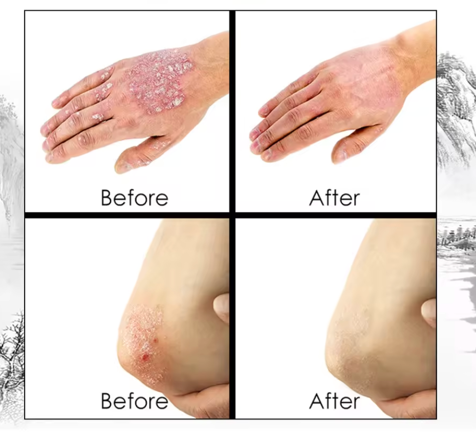 CREMA PSORIASIS UNGENTO