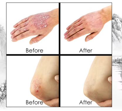 CREMA PSORIASIS UNGENTO